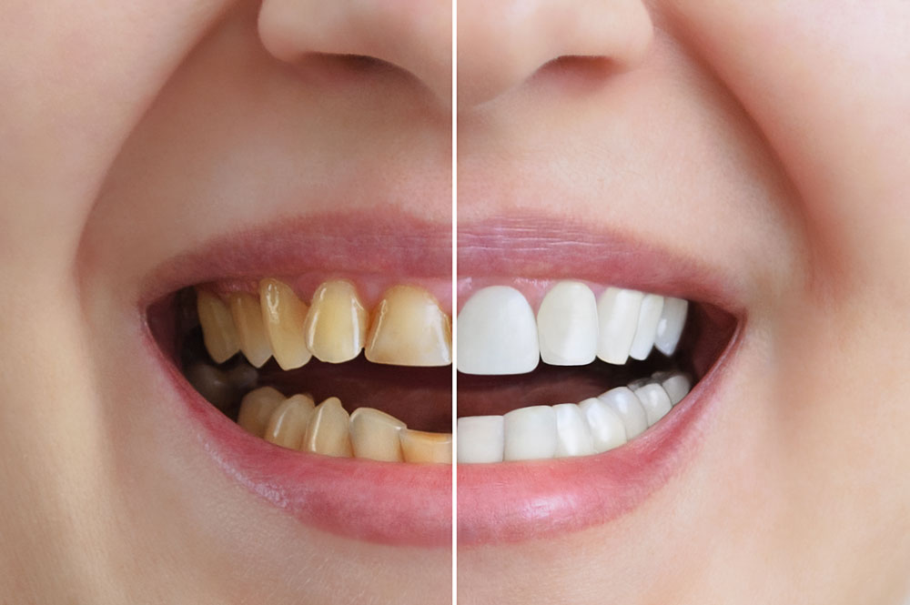 https://royalbeautyco.com.au/wp-content/uploads/2024/08/Treatment-And-Whitening-Of-Teeth-2.jpg